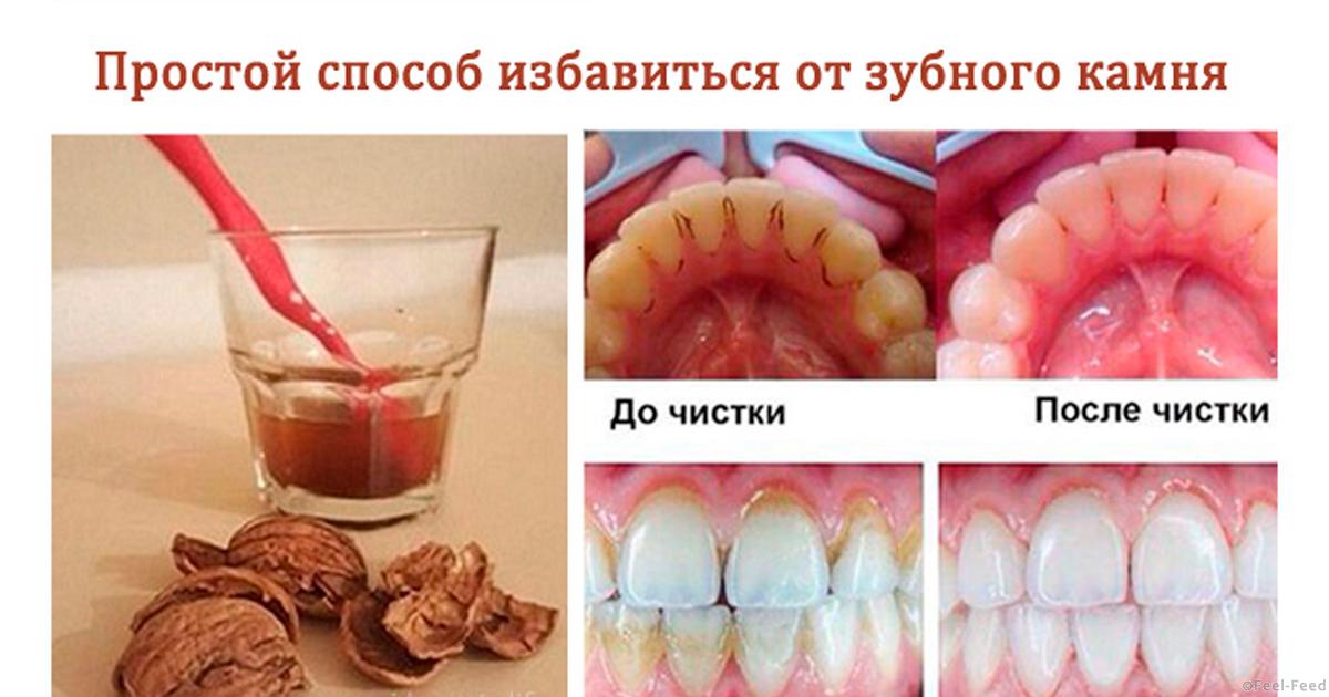 Как в домашних удалить зубную боль в домашних условиях Как в домашних удалить зубную боль в домашних условиях