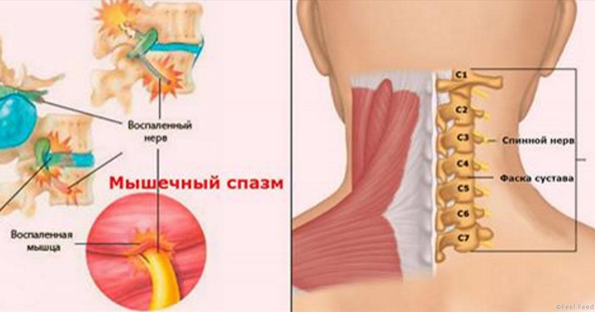 Как убрать мышечный спазм в шейном отделе Как убрать мышечный спазм в шейном отделе