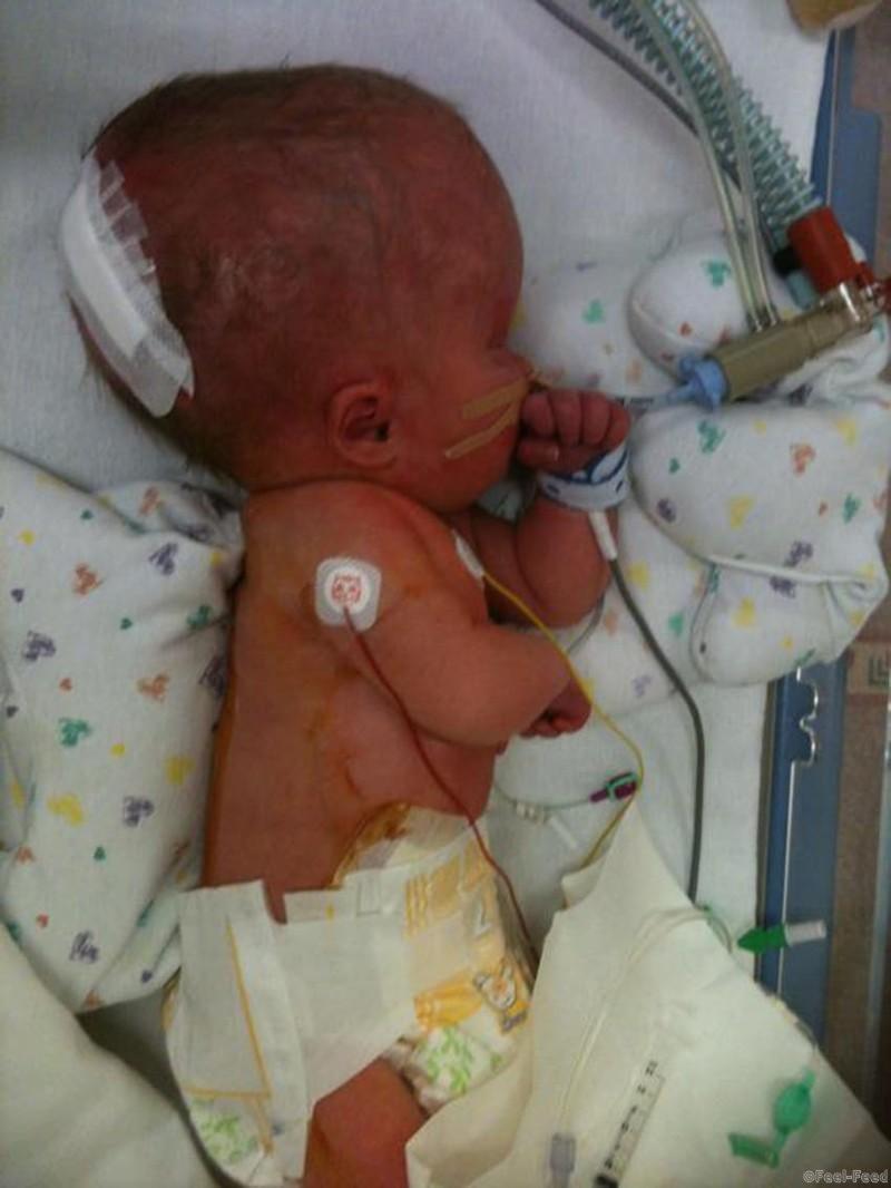 PIC FROM CATERS NEWS - (PICTURED: Noah when he was born and in the ICU ) - A brave toddler who was born with just 2% brain function has dumbfounded doctors after he recovered nearly all of its ability. Michelle Wall and her husband Rob were warned their unborn son Noah was unlikely to survive birth as it became apparent a back quarter of his brain was missing. On July 10, despite being told he would be paralysed from the chest down and suffer with spina bifida, the three-year-old shocked doctors after showing his brain miraculously had almost full function. SEE CATERS COPY.