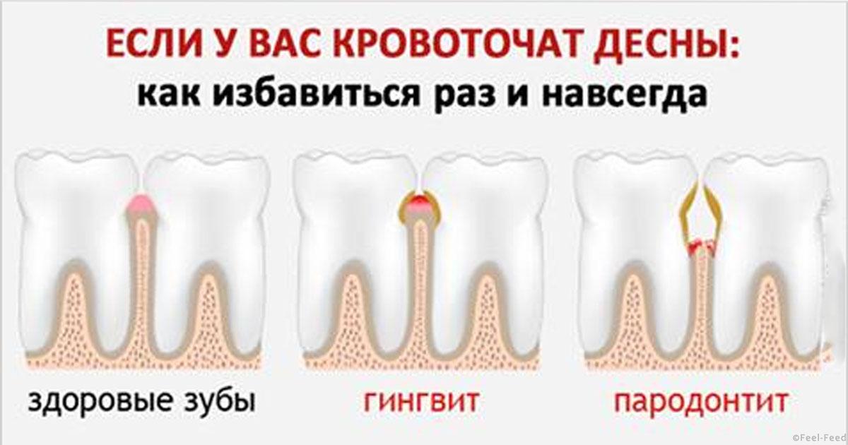 Кровоточат десна и налет на деснах Кровоточат десна и налет на деснах