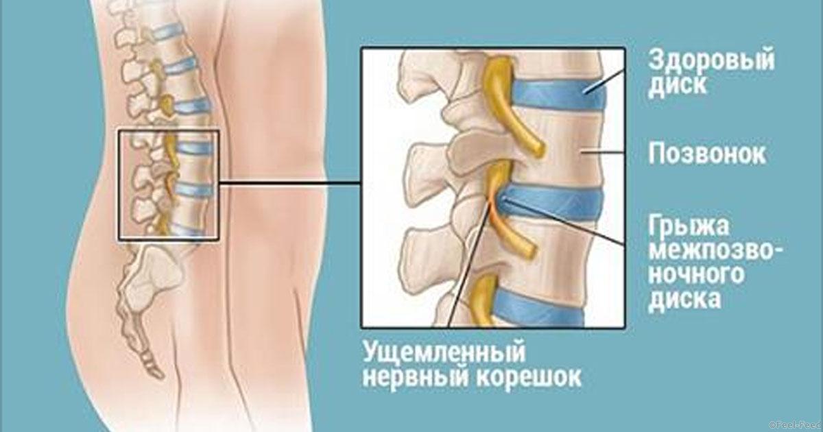 Упражнения от грыжи дисков позвоночника Упражнения от грыжи дисков позвоночника